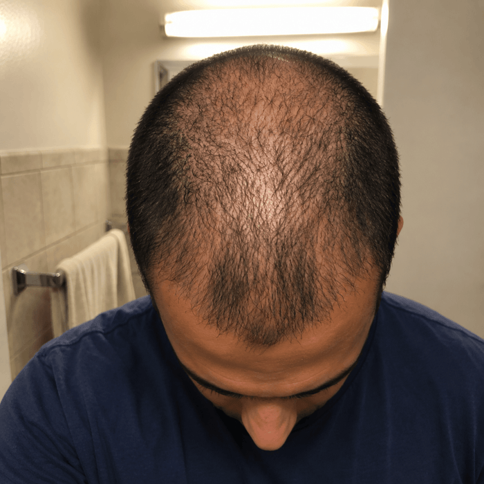 Diffused thinning before