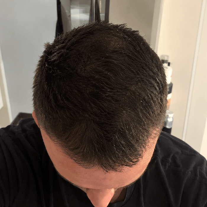 Hairline after