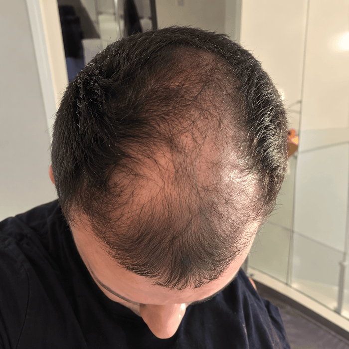 Hairline before